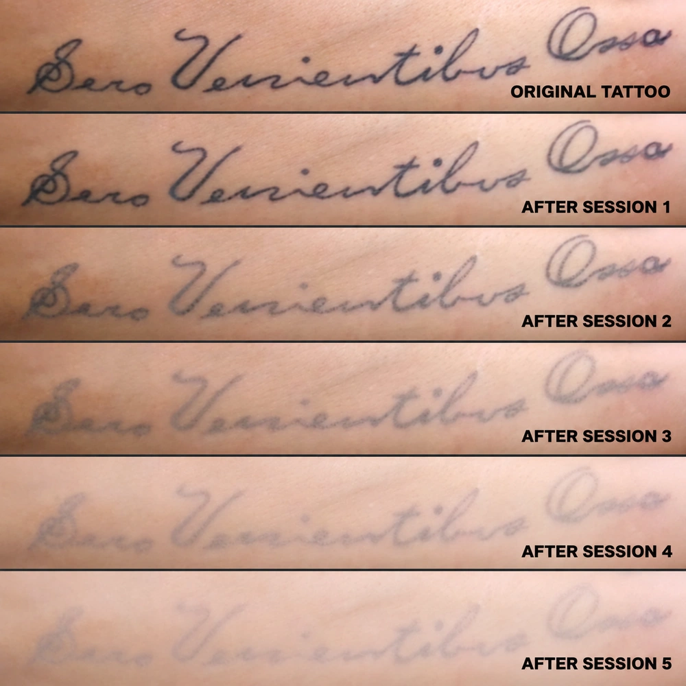 Online Tattoo Removal Training information for learners in Sonora, Mexico